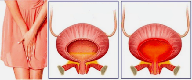 Chronische Zystitis